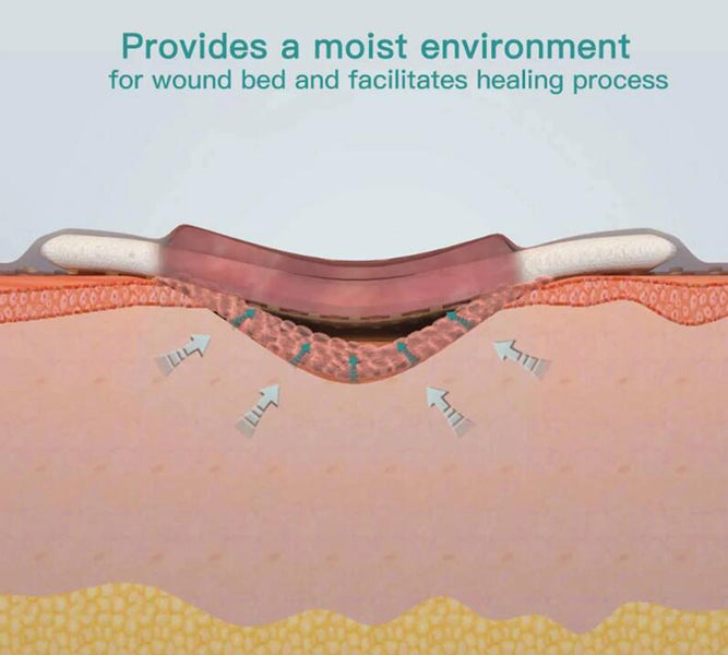 How Does Alginate Ag Dressing Work?